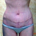 Tummy tuck recovery photo of scar