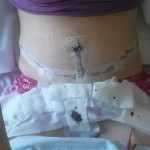 1 - Day after tummy tuck surgery with the tape still on