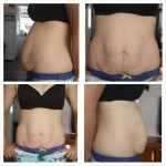 1 - when you should do tummy tuck
