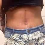 10 day after tummy tuck 2