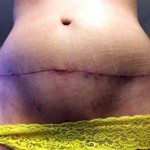 Swelling after tummy tuck abdominoplasty on 2 week