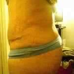 17th day after tummy tuck. Still somewhat swollen more on one side than the other