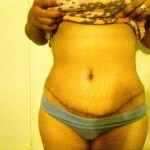 After tummy tuck