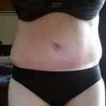 3wks post tummy tuck op, 1wk post 2nd op due to infection wound has to be re opened and cleaned