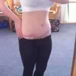 7 and half months after tummy tucksurgery 2