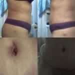 in a month after tummy tuck