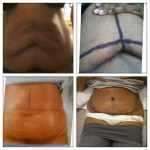 Before, after and during tummy tuck