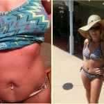 Before and later tummy tuck