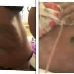 Before and one week after tummy tuck