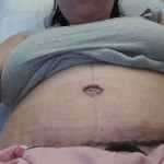 Day 2 after tummy tuck
