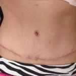 Eight months after tummy tuck