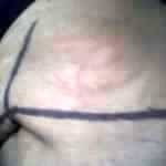 Markings of abdominoplasty