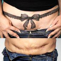 Tummy Tuck Tattoo To Cover Scar Pictures (5)