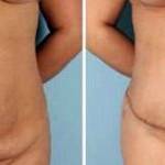 Tummy tuck before and after image 5