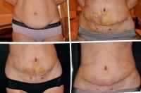 Tummy tuck scars before and after