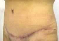 Abdominoplasty scar