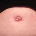 belly buttons take around 5 months to heal fater tummy tuck