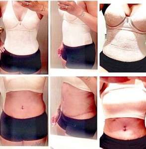 Before and after tummy tuck in Kansas city