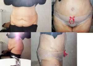 Before and after tummy tuck in Fort Myers