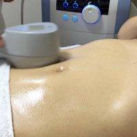 Exilis Elite Tummy Tuck