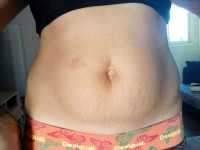 Fort Myers tummy tuck