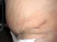 MD tummy tuck scar