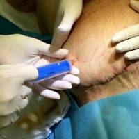 Seroma After Tummy Tuck Non Surgical Removal