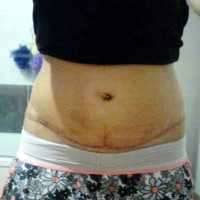 Tummy tuck scar Fort Myers