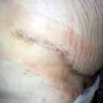 Tummy tuck scar treatment