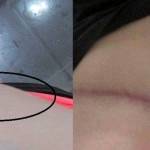 Tummy tuck seroma under scar