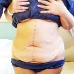 A tummy tuck and breast lift