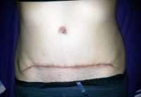 Hybrid tummy tuck scar