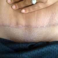 Scar after tummy tuck revision