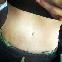 Stretch marks before tummy tuck revision