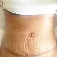 Swelling after abdominoplasty