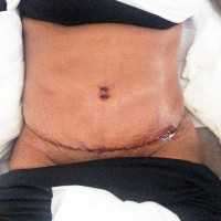 Swelling after tummy tuck surgery
