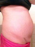 Abdominoplasty before and after pregnancy