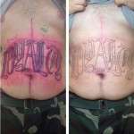 Abdominoplasty surgery tattoos to cover stretch marks