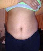 Losing weight before abdominoplasty