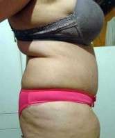 Photo weight loss before tummy tuck