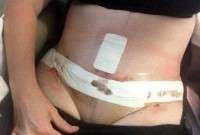 Recovery from tummy tuck surgery photo