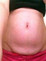 The tummy tuck before and after pregnancy