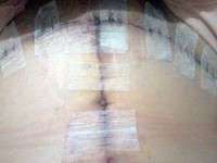 Tummy tuck scarring after operation