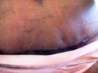 Tummy tuck scarring after sugery