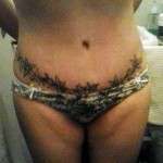 tummy tuck scar surgery tattoo pictures