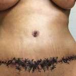 tummy tuck surgery scar tattoo pictures