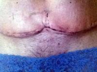 Dog Ears After Tummy Tuck image