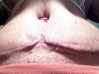 Dog Ears After Tummy Tuck photo