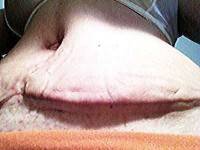 Dog Ears After Tummy Tuck picture