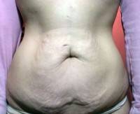 Good candidate for tummy tuck operation